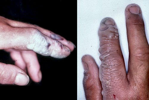 Acid and chemical burns – په تېزابو او کیمیاوي توکو سوزېدنه
